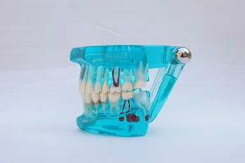 1PC Zubný Implantát Ochorenia Zubov Model s Obnovy Mosta Zub na Lekárske Zubár Školenia a Výučby 5 Farieb