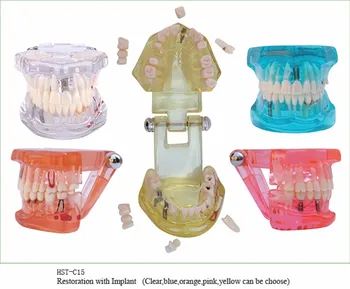 1PC Zubný Implantát Ochorenia Zubov Model s Obnovy Mosta Zub na Lekárske Zubár Školenia a Výučby 5 Farieb