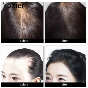 Zázvor Rast Vlasov Podstate Olej Účinný Extrakt Proti Vyživujú Vlasové Korienky Liečba, Prevencia Vypadávania Vlasov Starostlivosť O Vlasy Produkty